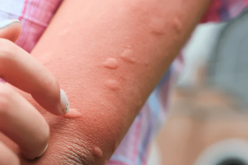 Piqûres de moustique sur un bras : boutons isolés en relief